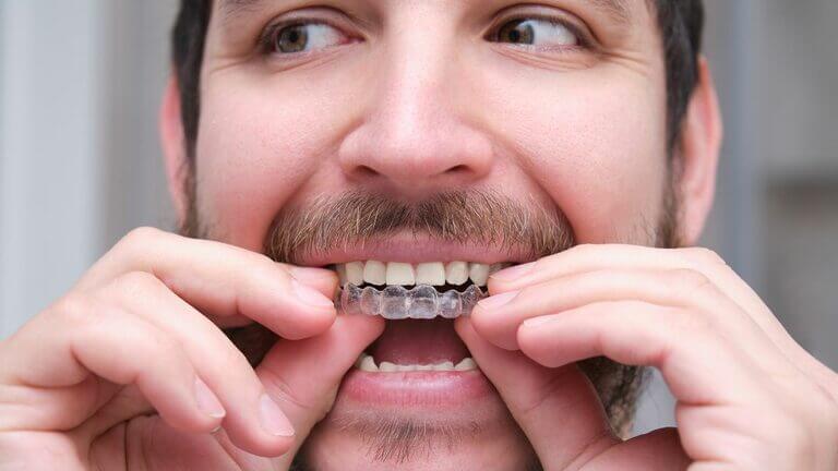 Apiñamiento Dental: Por Qué se Mueven los Dientes y Cómo Solucionarlo