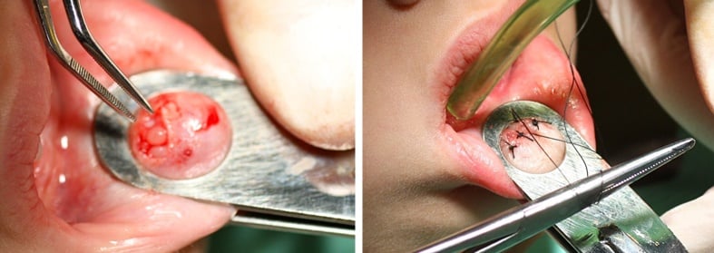 Mucocele: Cómo curar el bulto transparente en el labio