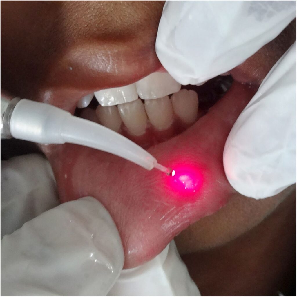 Mucocele: Cómo curar el bulto transparente en el labio