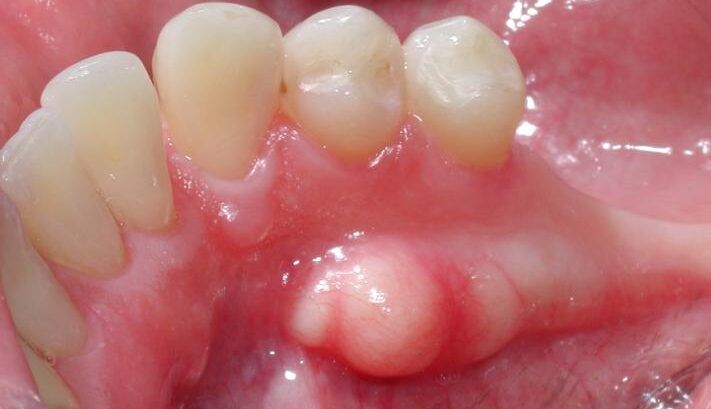 Torus mandibular: ¿Es peligroso ese bulto de hueso en la boca?