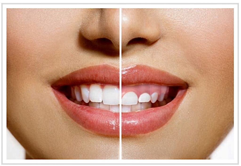 Sonrisa asimétrica: qué la causa (dientes, encías, huesos, músculos), cuándo funcionan las carillas, cuándo necesitas cirugía y cómo elegir bien.