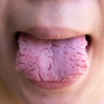 Lengua geográfica: Síntomas y tratamiento de las manchas