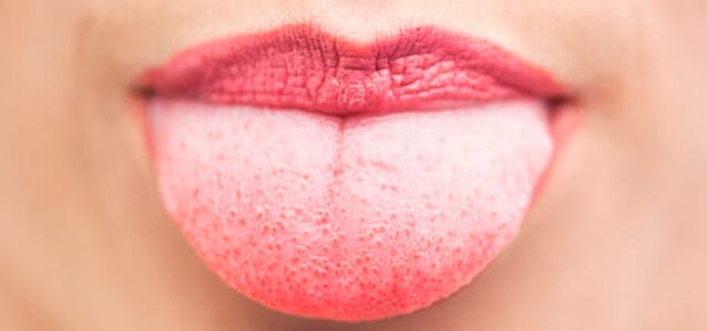 Lengua geográfica: Síntomas y tratamiento de las manchas Lengua geográfica: Síntomas y tratamiento de las manchas