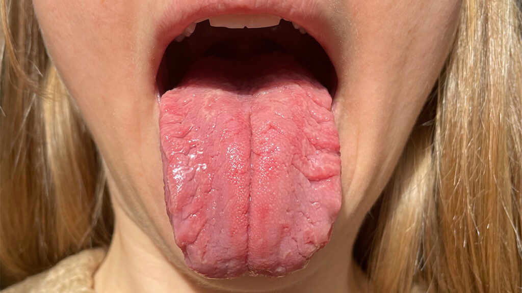 Lengua geográfica: Síntomas y tratamiento de las manchas Lengua geográfica: Síntomas y tratamiento de las manchas