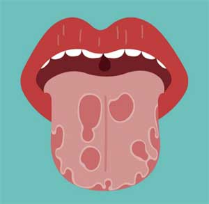 Lengua geográfica: Síntomas y tratamiento de las manchas Lengua geográfica: Síntomas y tratamiento de las manchas