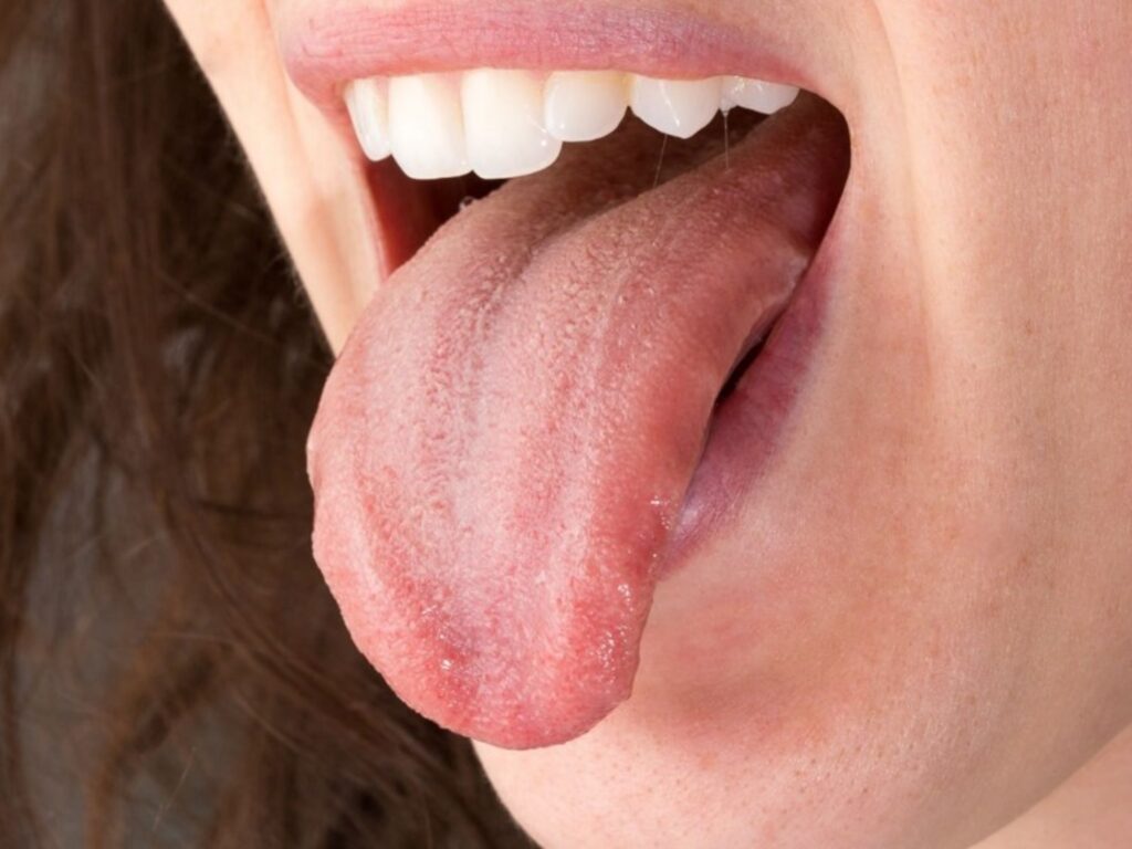 Lengua geográfica: Síntomas y tratamiento de las manchas Lengua geográfica: Síntomas y tratamiento de las manchas