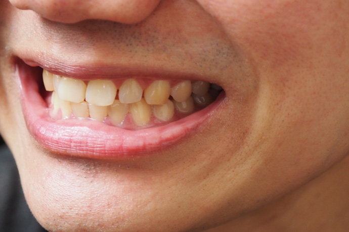 Manchas marrones en los dientes: Diferencias con caries Manchas marrones en los dientes: Diferencias con caries