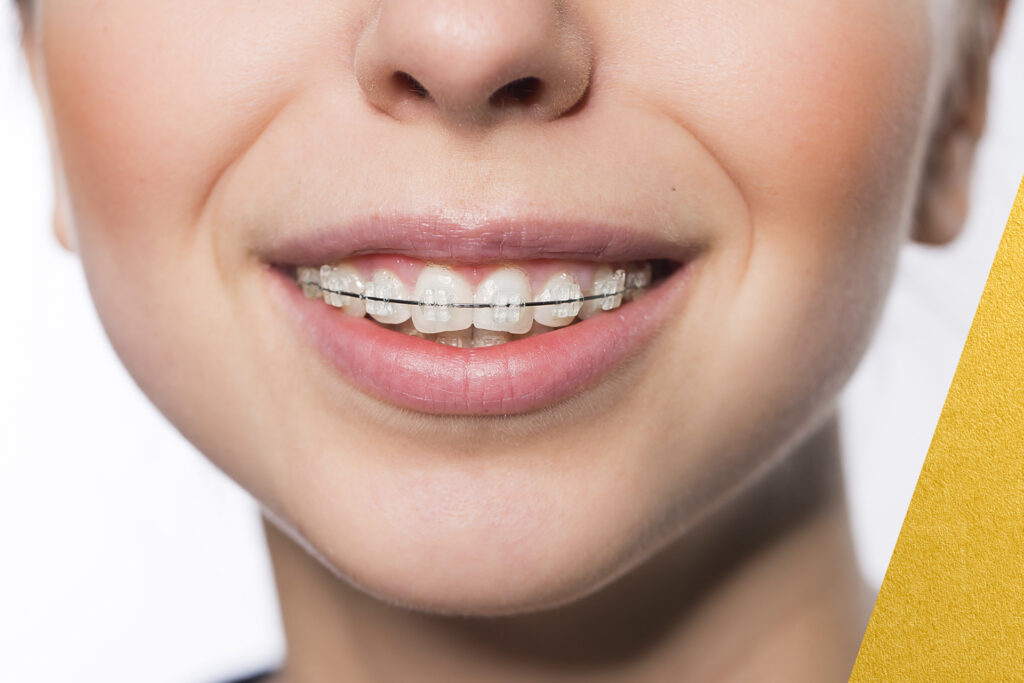 Apiñamiento Dental: Por Qué se Mueven los Dientes y Cómo Solucionarlo