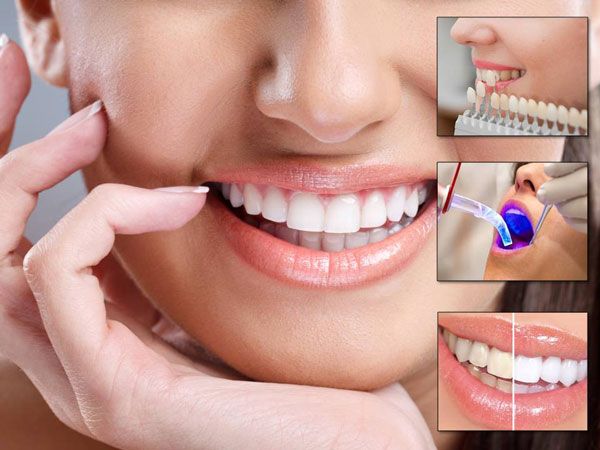 Manchas marrones en los dientes: Diferencias con caries Manchas marrones en los dientes: Diferencias con caries