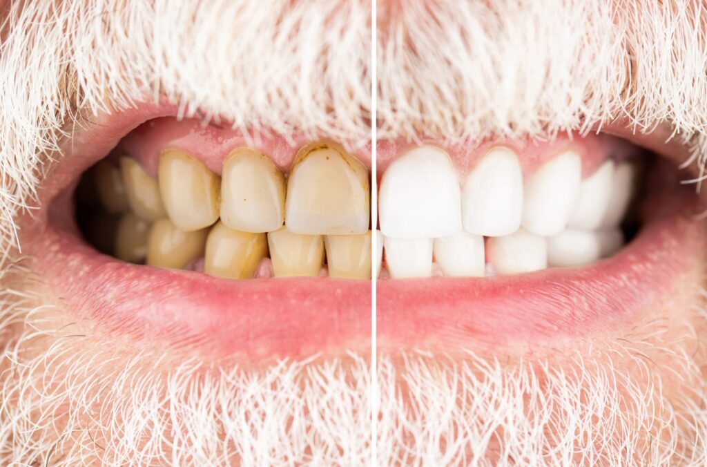 Manchas marrones en los dientes: Diferencias con caries Manchas marrones en los dientes: Diferencias con caries