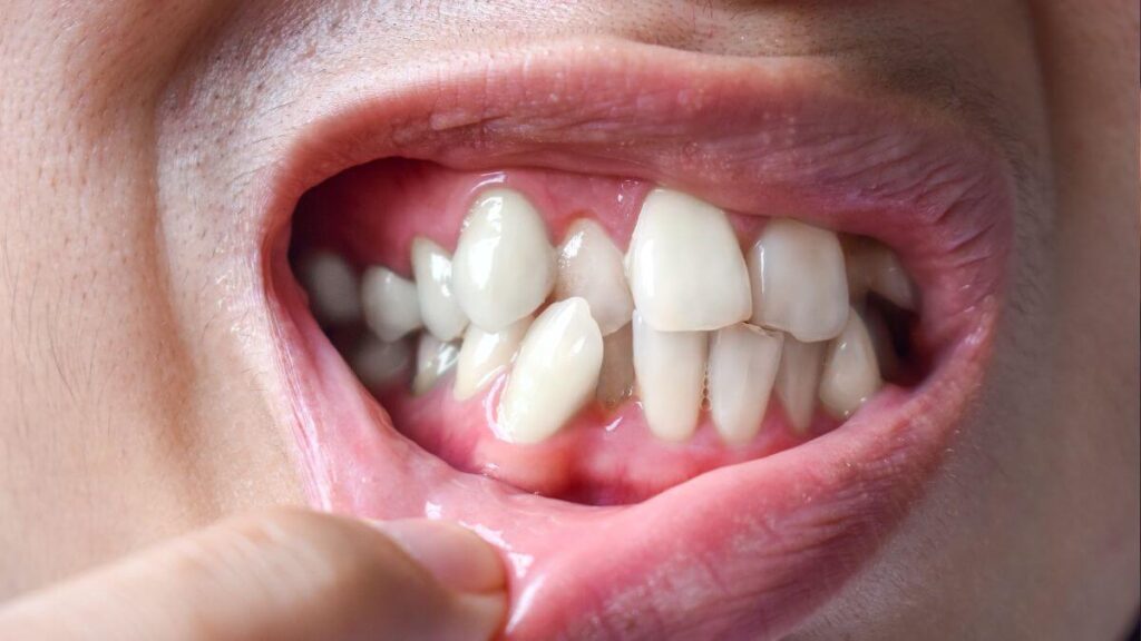 Apiñamiento Dental: Por Qué se Mueven los Dientes y Cómo Solucionarlo