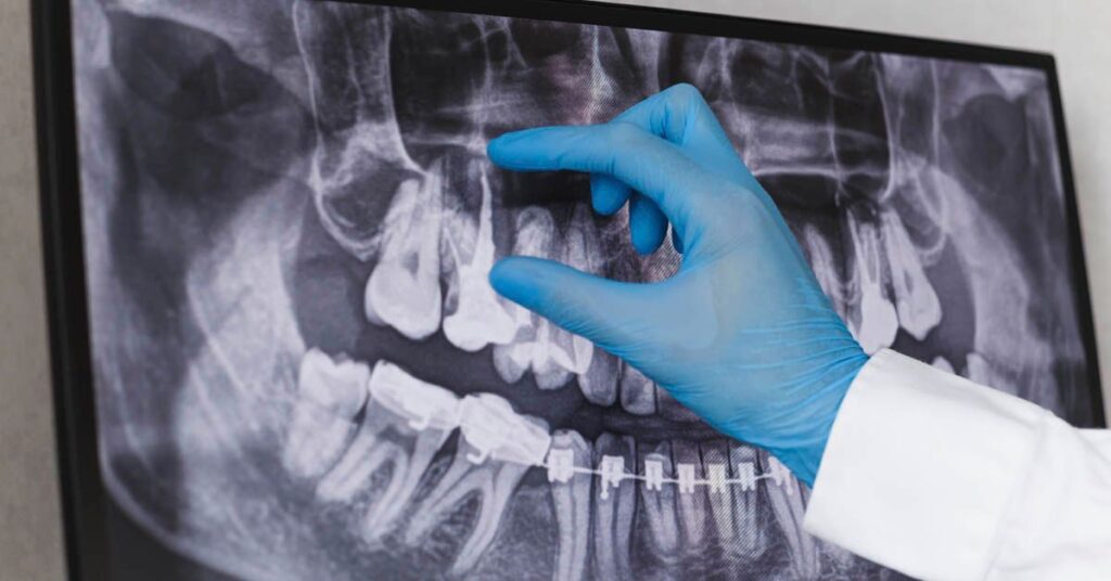 Apiñamiento Dental: Por Qué se Mueven los Dientes y Cómo Solucionarlo