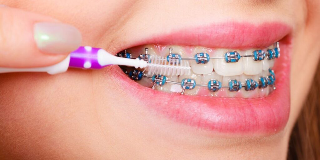 Mantenimiento de Ortodoncia: Cómo Cuidar tus Brackets y Alineadores Correctamente
