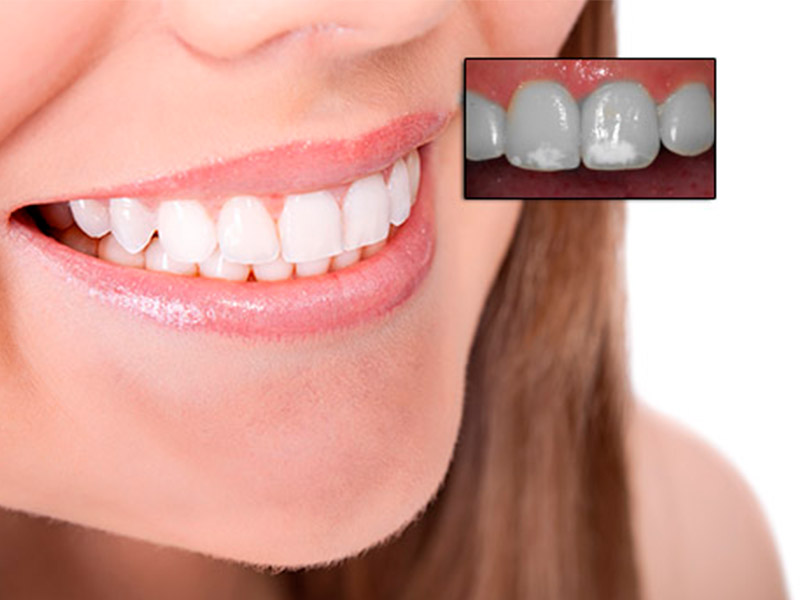 fluorosis dental fluorosis dental