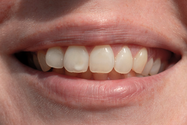 fluorosis dental fluorosis dental