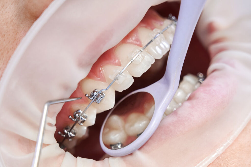 Mantenimiento de Ortodoncia: Cómo Cuidar tus Brackets y Alineadores Correctamente