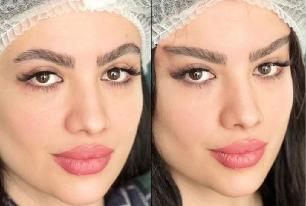 Foxy Eyes: Levantar la mirada con hilos tensores