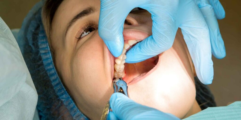 Diente avulsionado: Qué hacer si se te cae un diente por un golpe