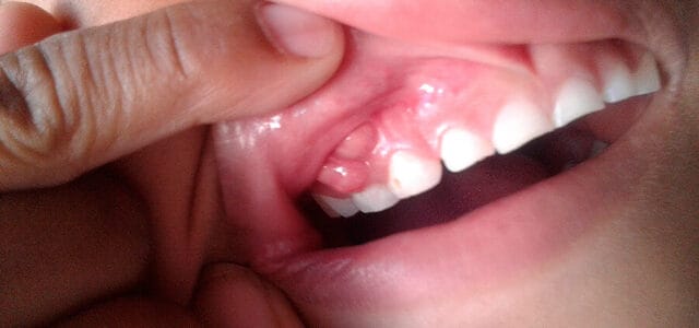 Fístula en la encía: Diferencia con el flemón y cómo curarla