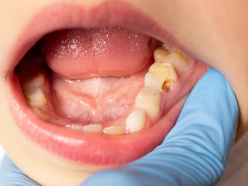 Fístula en la encía: Diferencia con el flemón y cómo curarla