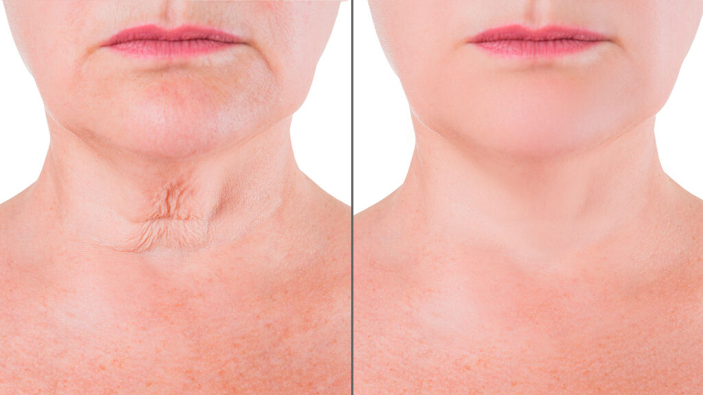 Anillos de Venus: Cómo eliminar las arrugas del cuello