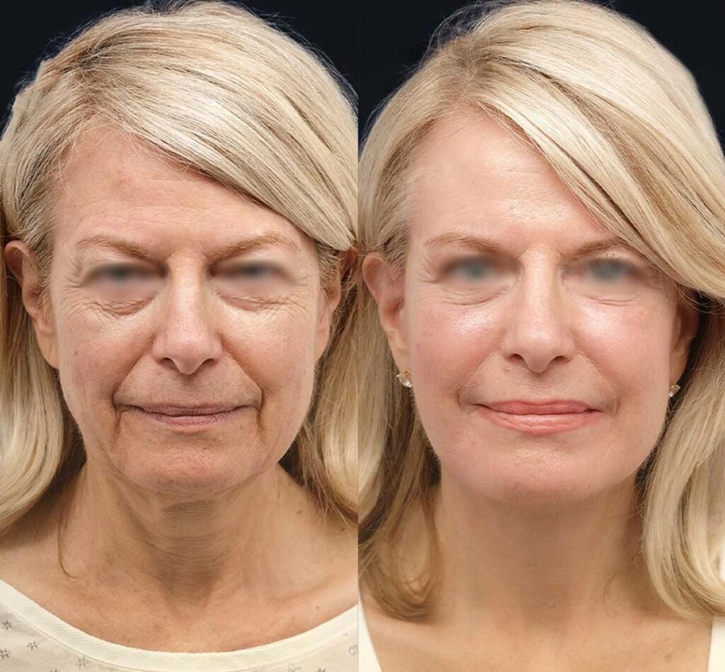 Anillos de Venus: Cómo eliminar las arrugas del cuello