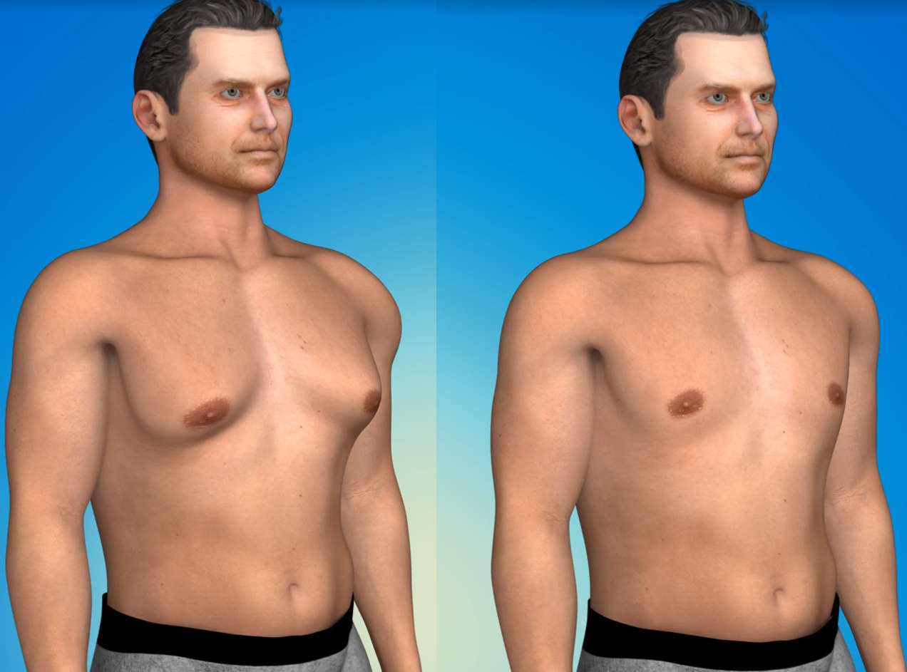 Ginecomastia en hombres sin cirugía: ¿Es posible?