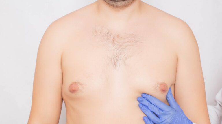 Ginecomastia en hombres sin cirugía: ¿Es posible?