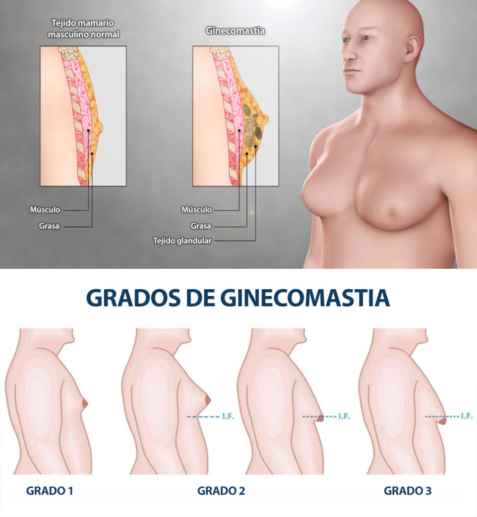 Ginecomastia en hombres sin cirugía: ¿Es posible?