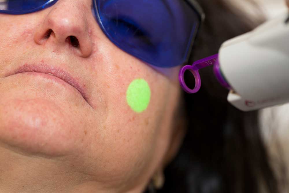 Rosácea en la cara: Tratamientos con láser vascular