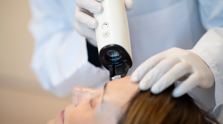 Rosácea en la cara: Tratamientos con láser vascular