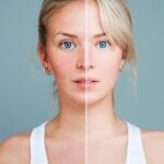 Rosácea en la cara: Tratamientos con láser vascular