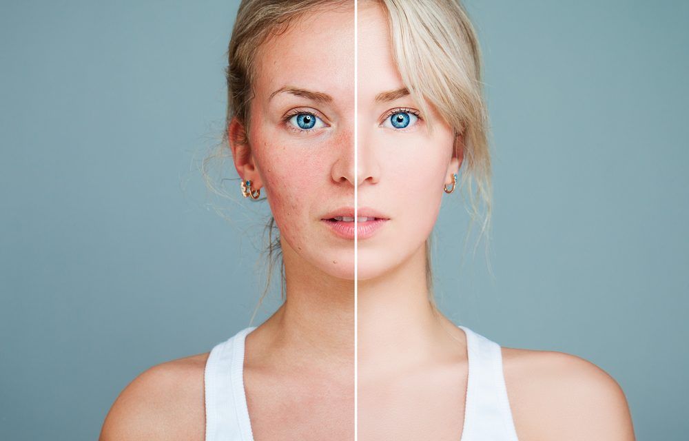 Rosácea en la cara: Tratamientos con láser vascular