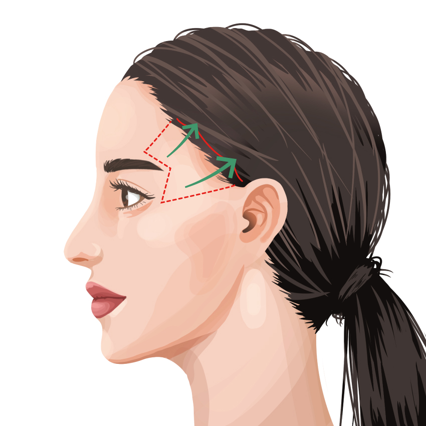 Lifting de Vampiro (PRP Facial): Beneficios reales