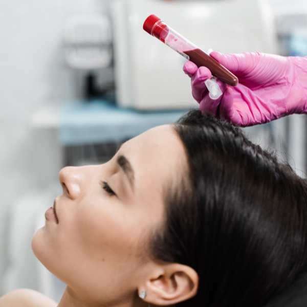 Lifting de Vampiro (PRP Facial): Beneficios reales