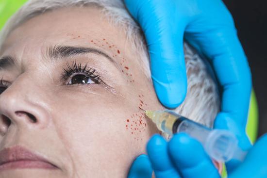 Lifting de Vampiro (PRP Facial): Beneficios reales