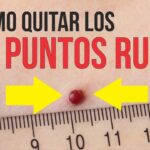 Puntos Rubí: Por qué salen y cómo quitarlos