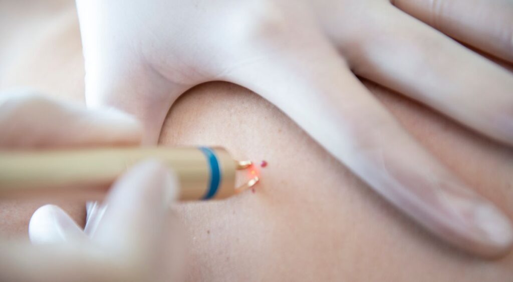 Puntos Rubí: Por qué salen y cómo quitarlos