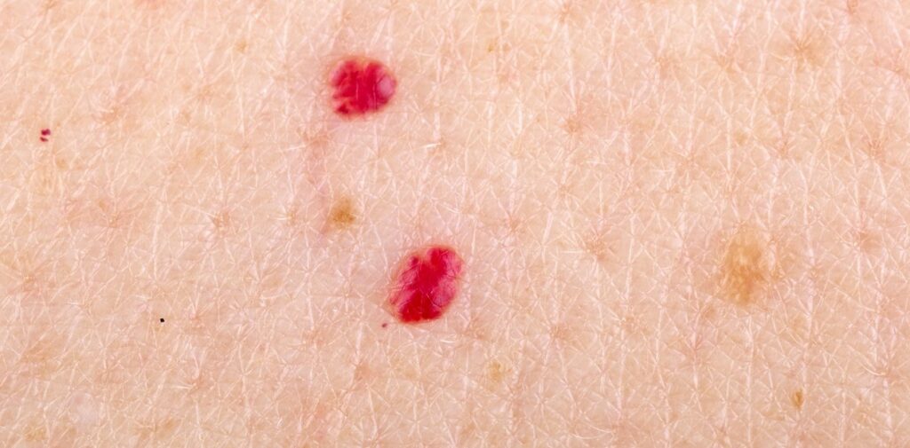Puntos Rubí: Por qué salen y cómo quitarlos