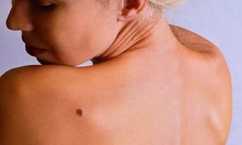 Puntos Rubí: Por qué salen y cómo quitarlos