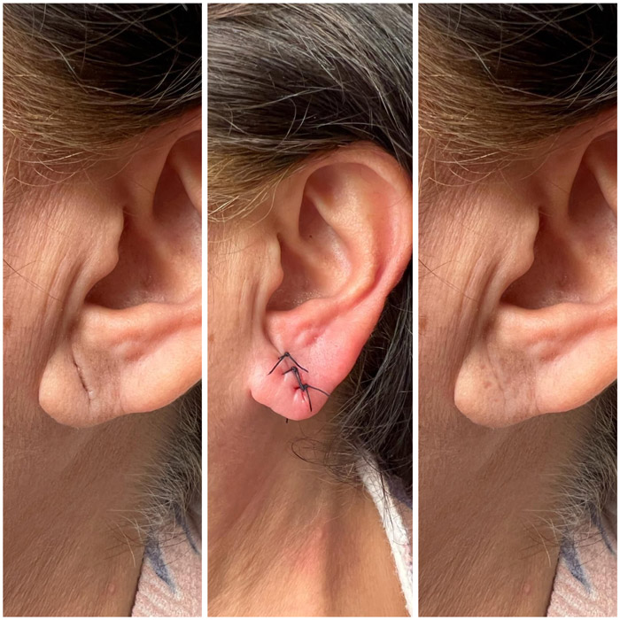 Lóbulos de las orejas rasgados: Reparación con ácido hialurónico