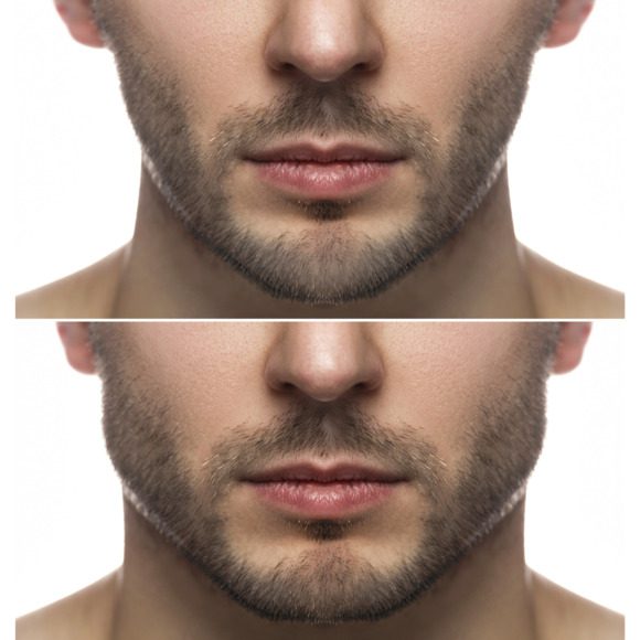 Masculinización facial: Definir mandíbula y mentón en hombres