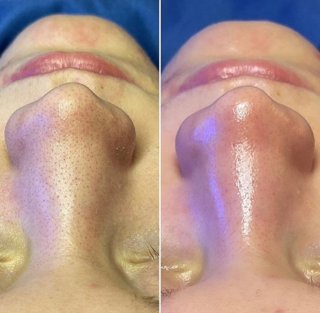 Hydrafacial: Diferencias con una limpieza facial profunda