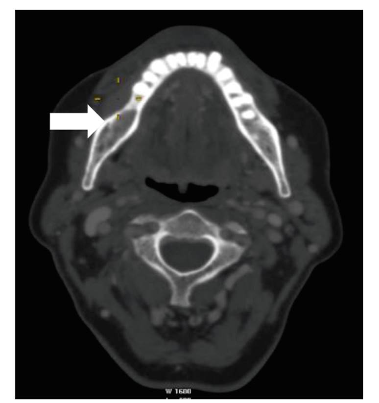 Parestesia dental: Hormigueo en el labio tras el dentista