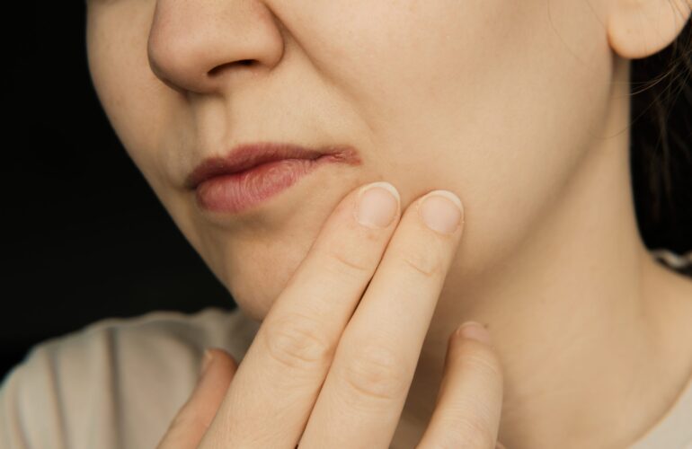 Queilitis angular (Boqueras): Causas y tratamiento rápido