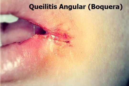 Queilitis angular (Boqueras): Causas y tratamiento rápido