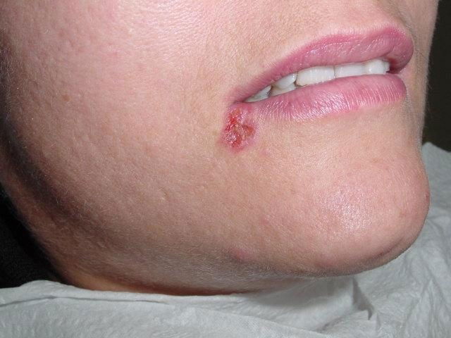 Queilitis angular (Boqueras): Causas y tratamiento rápido