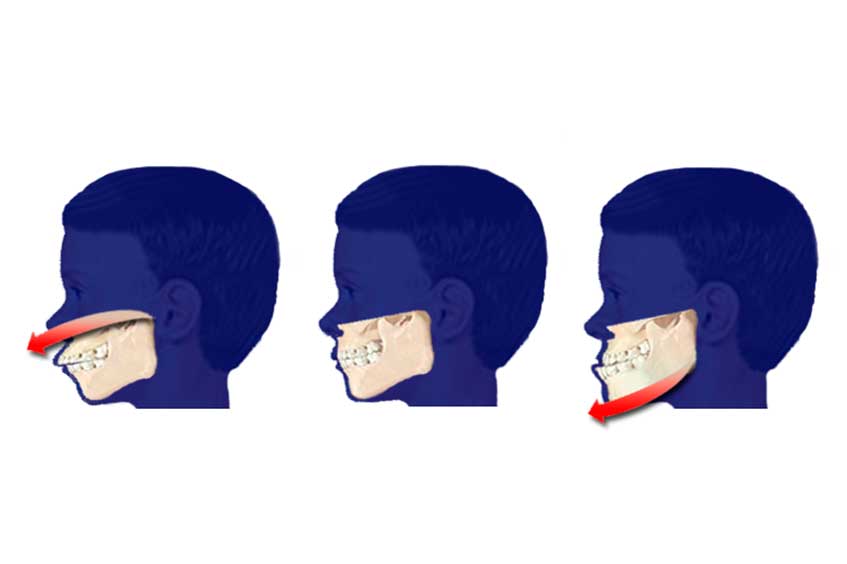 Mentón retraído (Retrognatia): Solución estética sin cirugía