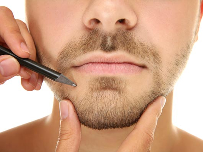 Mentón retraído (Retrognatia): Solución estética sin cirugía