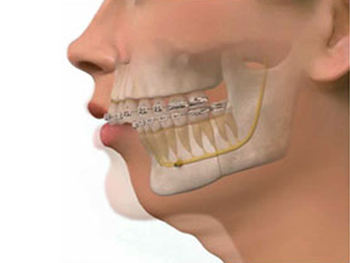 Mentón retraído (Retrognatia): Solución estética sin cirugía